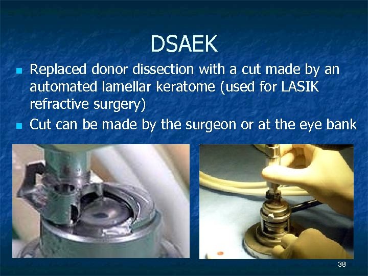 DSAEK n n Replaced donor dissection with a cut made by an automated lamellar