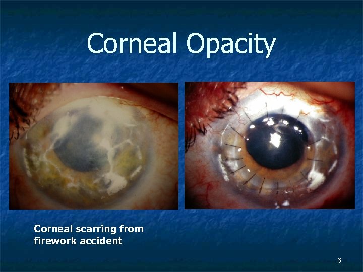Corneal Opacity Corneal scarring from firework accident 6 