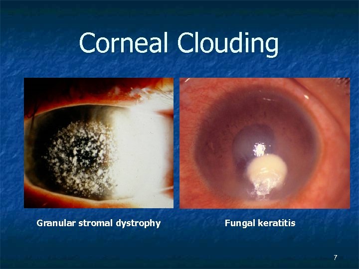 Corneal Clouding Granular stromal dystrophy Fungal keratitis 7 