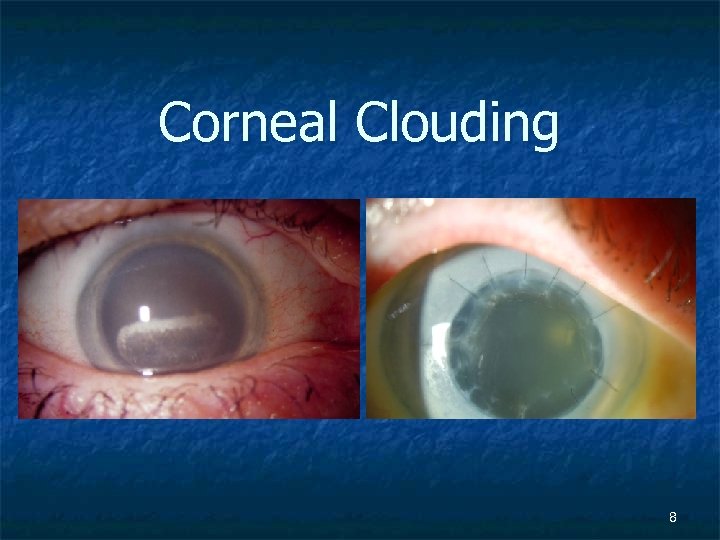 Corneal Clouding 8 