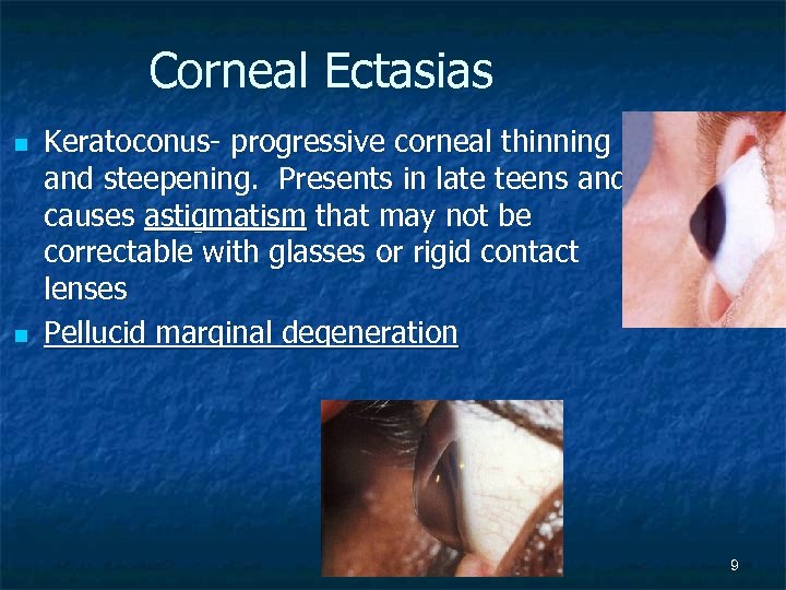 Corneal Ectasias n n Keratoconus- progressive corneal thinning and steepening. Presents in late teens