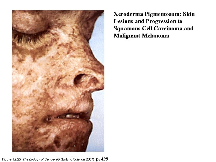 Xeroderma Pigmentosum: Skin Lesions and Progression to Squamous Cell Carcinoma and Malignant Melanoma Figure