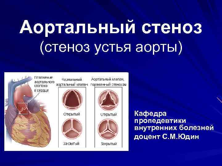 Аортальный клапан сколько створок