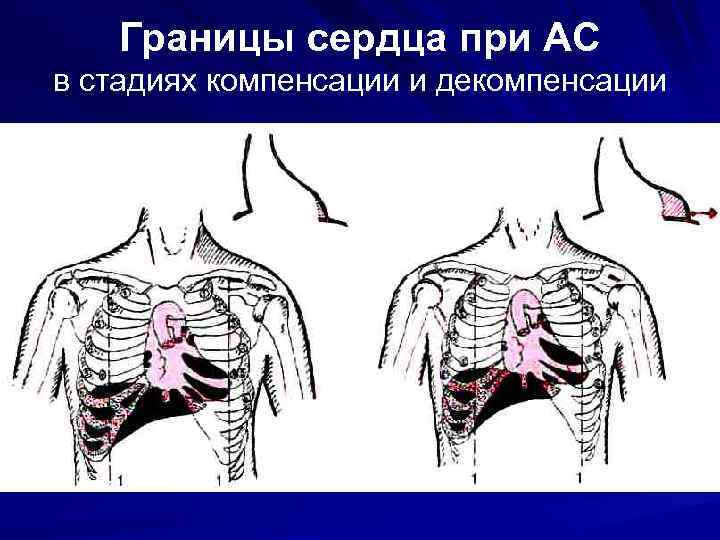 Аускультативная картина при аортальном стенозе характеризуется появлением