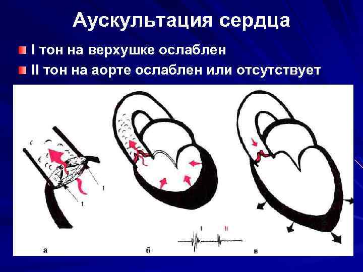 Аортальный стеноз градиент