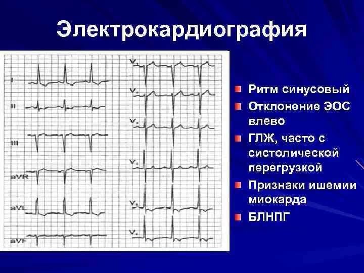 Электрокардиография Ритм синусовый Отклонение ЭОС влево ГЛЖ, часто с систолической перегрузкой Признаки ишемии миокарда