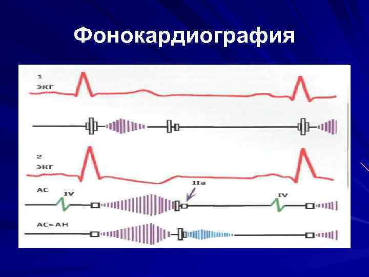 Фонокардиография 