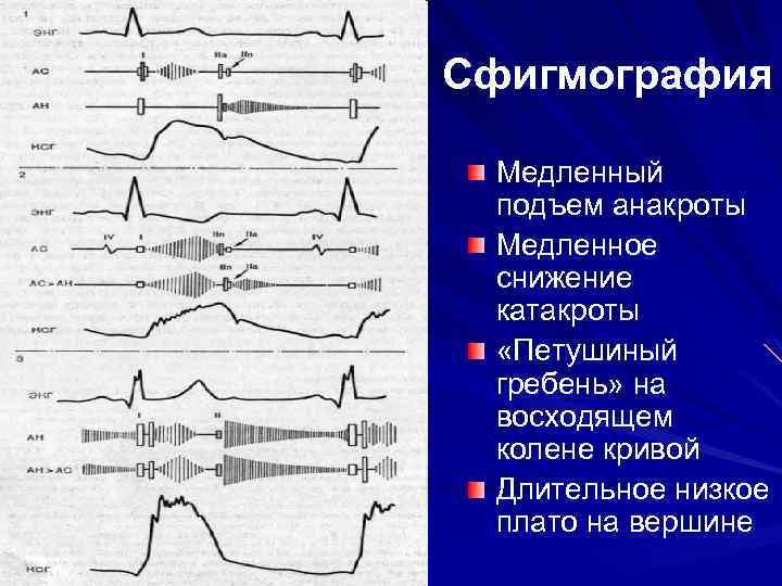 Нарисовать вид сфигмограммы лучевой артерии указать элементы сфигмограммы