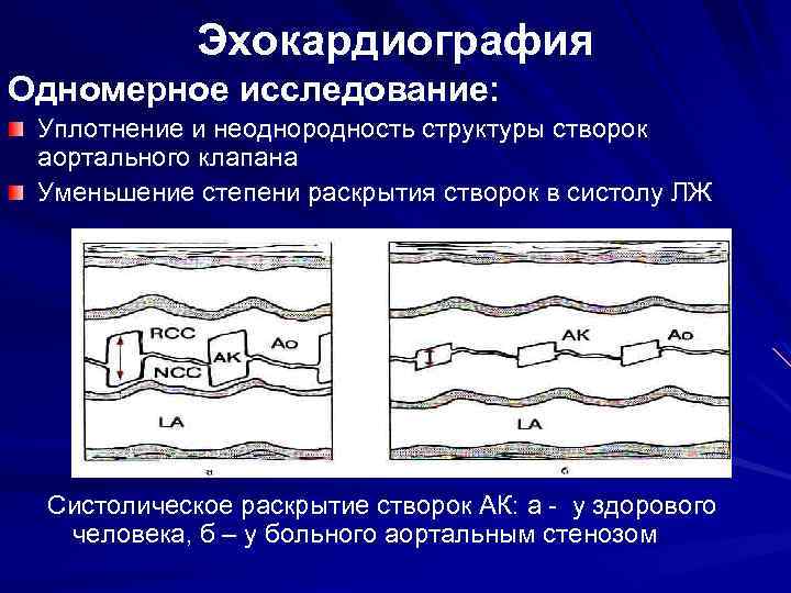 Расхождение створок аортального клапана