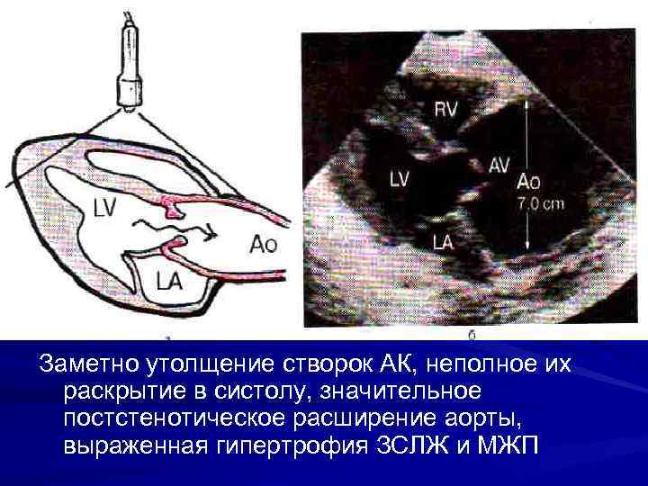 Утолщение створок аортального клапана