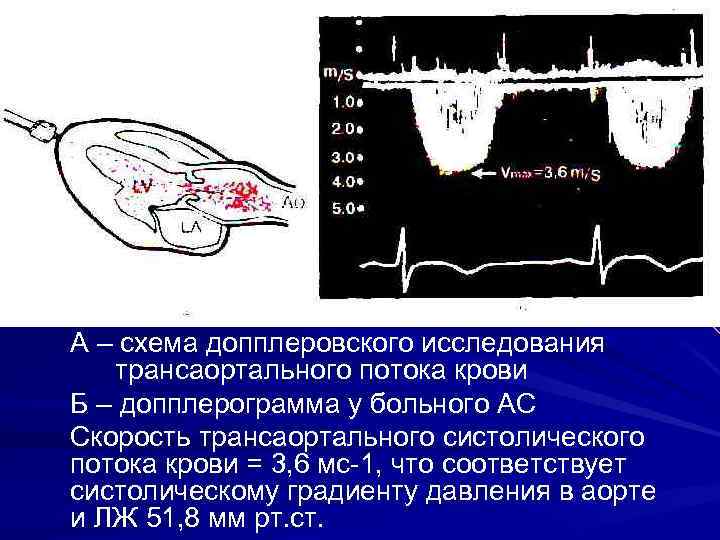 Градиент давления это. Систолический поток на аорте. Трансаортальный кровоток. Трансаортальный поток. Допплерограмма аорты схема.