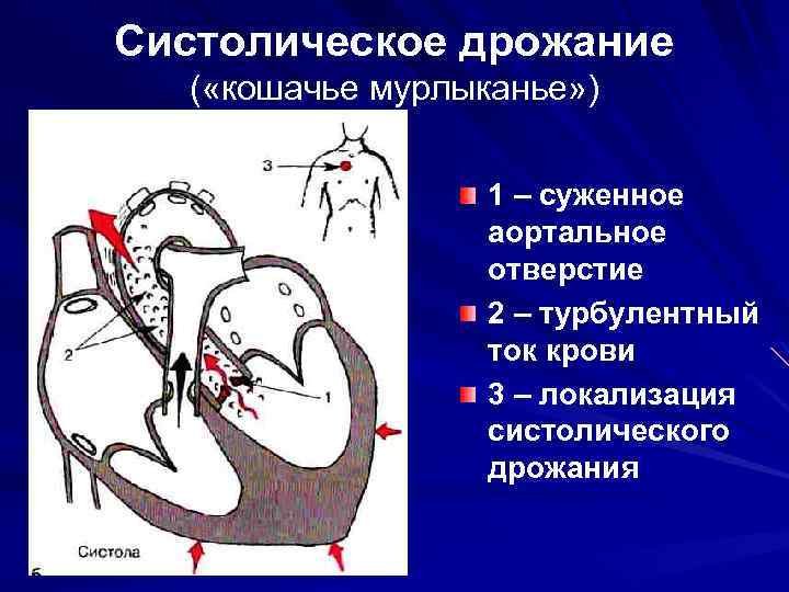 Аортальный стеноз градиент