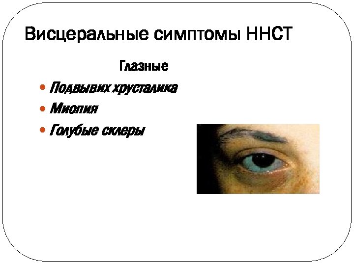 Висцеральные симптомы ННСТ Глазные Подвывих хрусталика Миопия Голубые склеры 