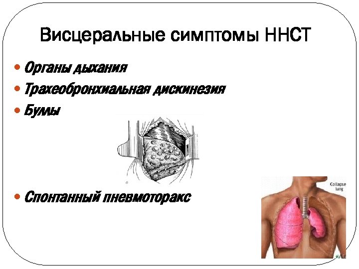 Висцеральные симптомы ННСТ Органы дыхания Трахеобронхиальная дискинезия Буллы Спонтанный пневмоторакс 