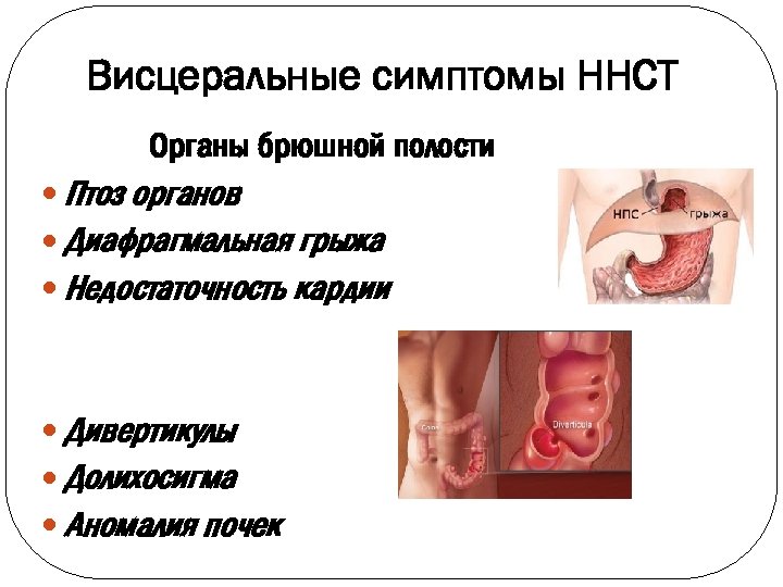 Висцеральные симптомы ННСТ Органы брюшной полости Птоз органов Диафрагмальная грыжа Недостаточность кардии Дивертикулы Долихосигма