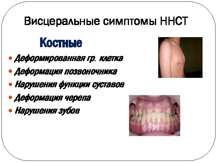 Висцеральные симптомы ННСТ Костные Деформированная гр. клетка Деформация позвоночника Нарушения функции суставов Деформация черепа