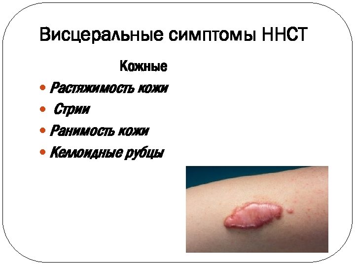 Висцеральные симптомы ННСТ Кожные Растяжимость кожи Стрии Ранимость кожи Келлоидные рубцы 