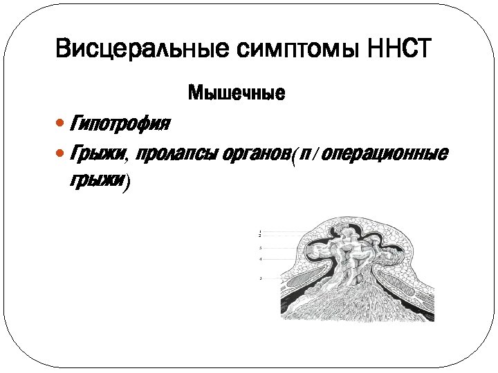 Висцеральные симптомы ННСТ Мышечные Гипотрофия Грыжи, пролапсы органов(п/операционные грыжи) 