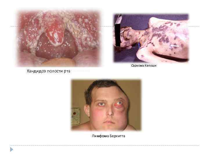 Саркома Капоши Кандидоз полости рта Лимфома Беркитта 