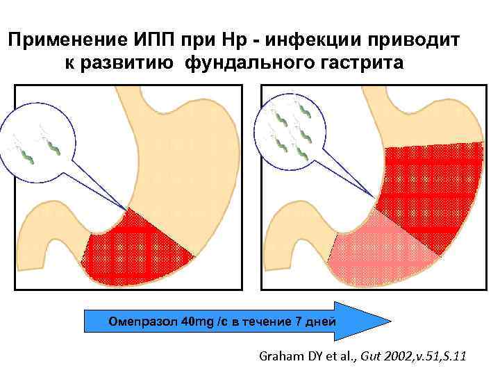 Применение ИПП при Нр - инфекции приводит к развитию фундального гастрита Омепразол 40 mg