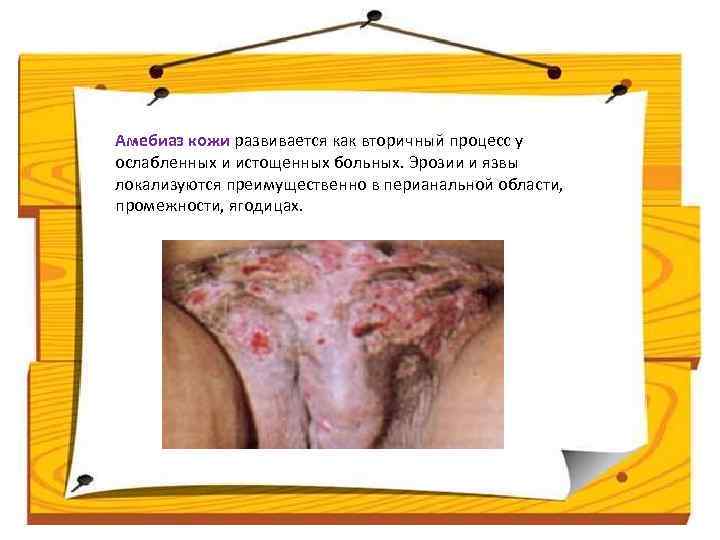 Амебиаз кожи развивается как вторичный процесс у ослабленных и истощенных больных. Эрозии и язвы