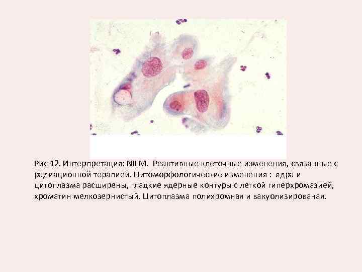 Часть клеток с реактивными изменениями. Многоядерные клетки в цитологии шейки матки. Клетки железистого эпителия с реактивными изменениями что это такое. Реактивные изменения клеток. Клетки с реактивно измененными ядрами.