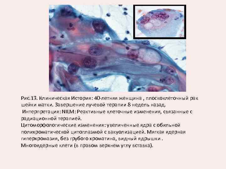 Рис. 13. Клиническая История: 40 -летняя женщина , плоскоклеточный рак шейки матки. Завершение лучевой