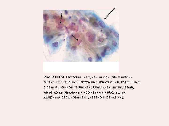 Часть клеток с реактивными изменениями. Атипичные эпителиальные клетки шейки матки. Реактивные клетки в цитологии шейки матки. Двухъядерные клетки в цитологии шейки матки. Цитология клетки с реактивными изменениями.