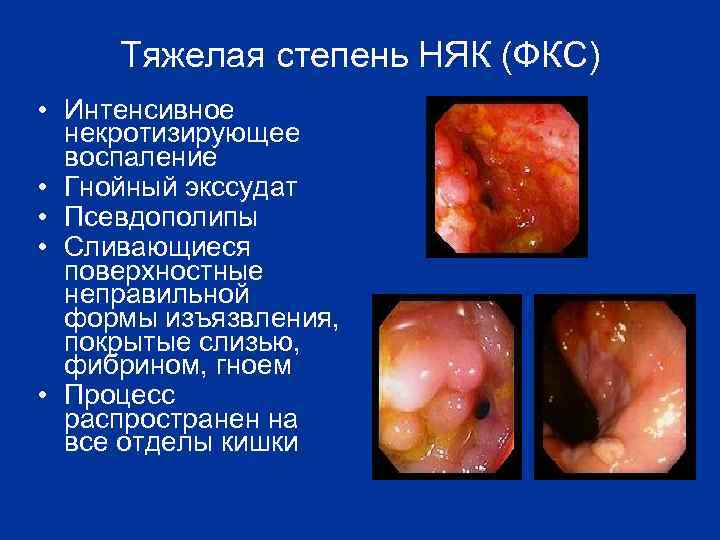 Тяжелая степень НЯК (ФКС) • Интенсивное некротизирующее воспаление • Гнойный экссудат • Псевдополипы •