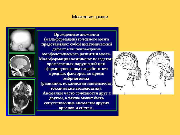 Мозговые грыжи 