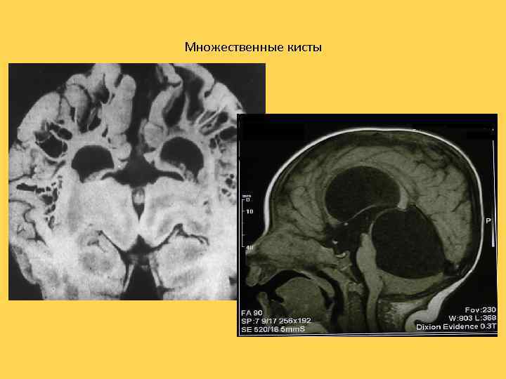 Множественные кисты 