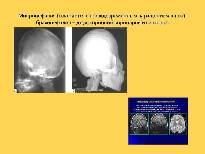 Микроцефалия (сочетается с преждевременным заращением швов): брахицефалия – двухсторонний коронарный синостоз. 