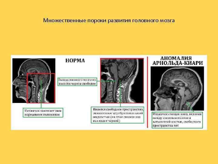 Множественные пороки развития головного мозга 