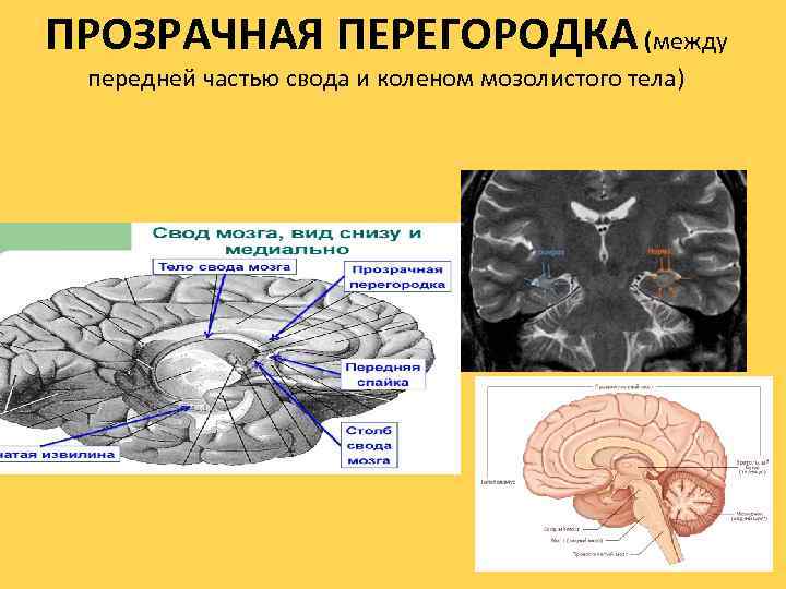 ПРОЗРАЧНАЯ ПЕРЕГОРОДКА (между передней частью свода и коленом мозолистого тела) 