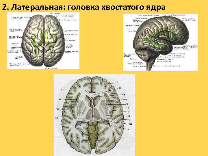 2. Латеральная: головка хвостатого ядра 