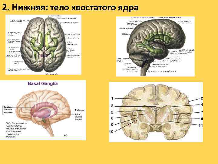 2. Нижняя: тело хвостатого ядра 