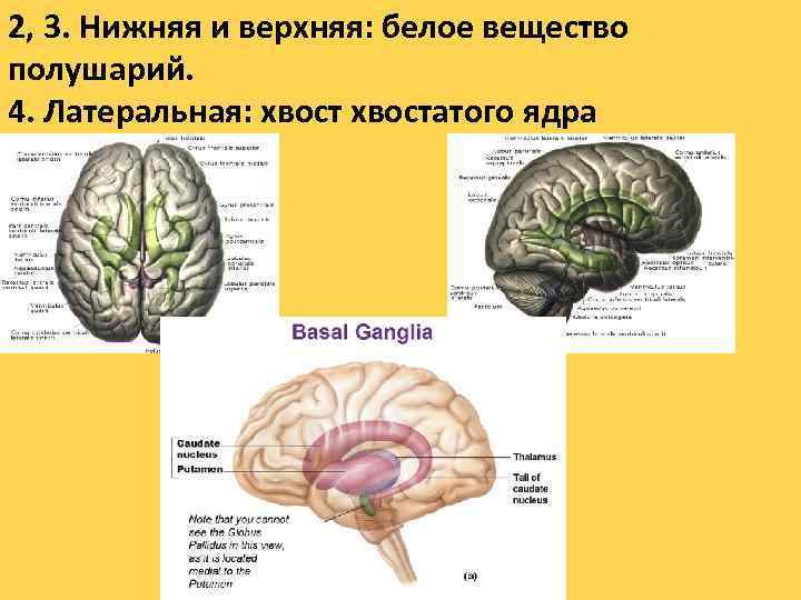 2, 3. Нижняя и верхняя: белое вещество полушарий. 4. Латеральная: хвостатого ядра 