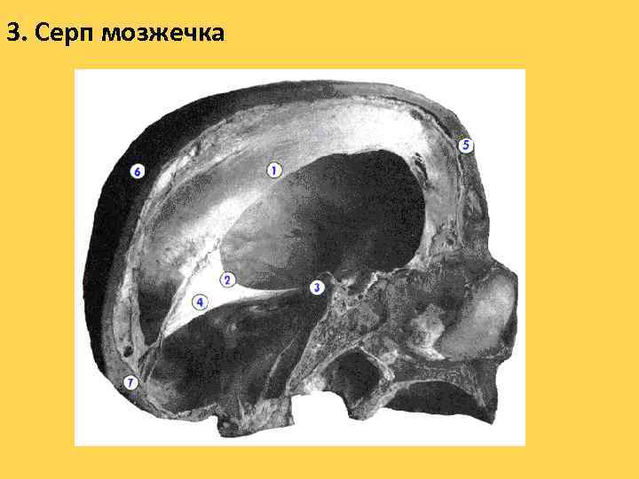 3. Серп мозжечка 