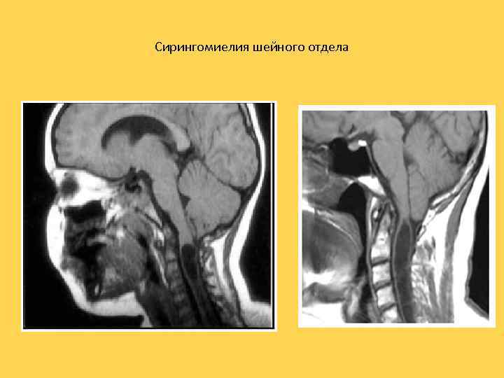 Сирингомиелия шейного отдела 
