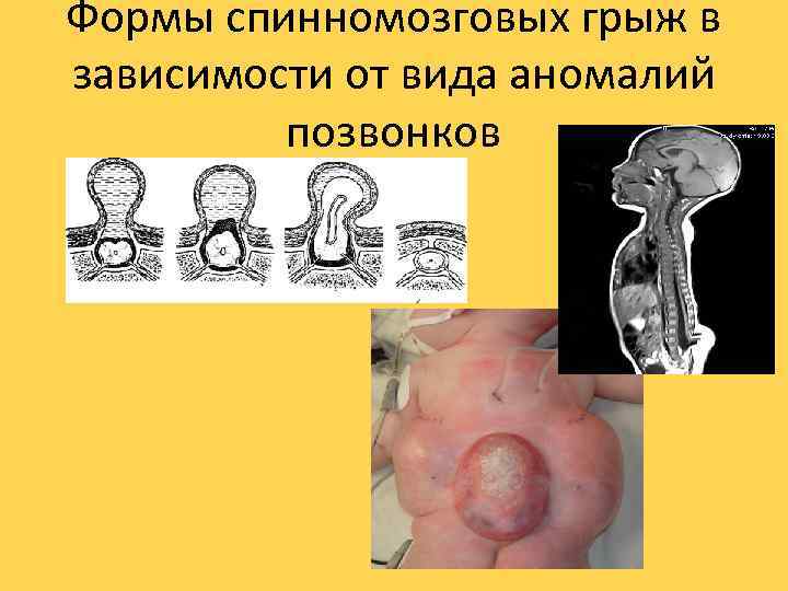 Формы спинномозговых грыж в зависимости от вида аномалий позвонков 