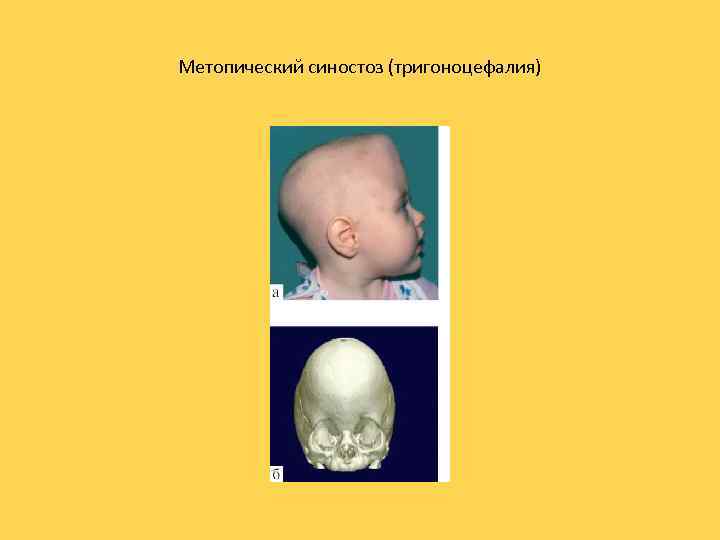 Метопический синостоз (тригоноцефалия) 