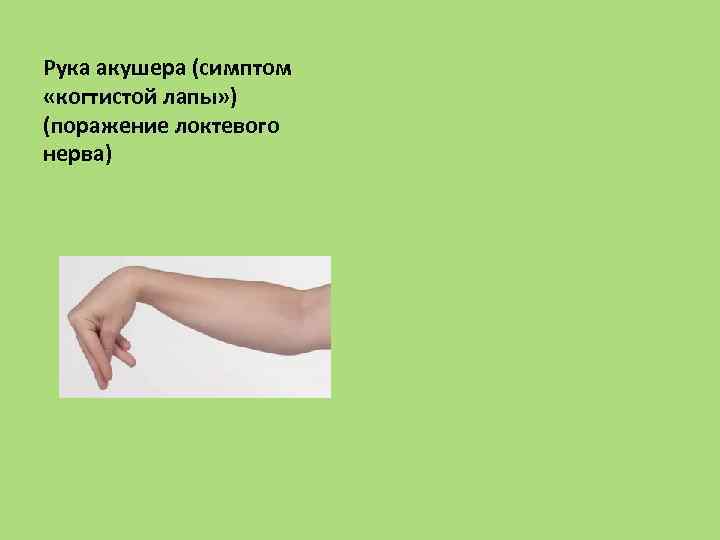 Рука акушера (симптом «когтистой лапы» ) (поражение локтевого нерва) 