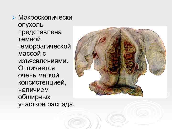 Ø Макроскопически опухоль представлена темной геморрагической массой с изъязвлениями. Отличается очень мягкой консистенцией, наличием