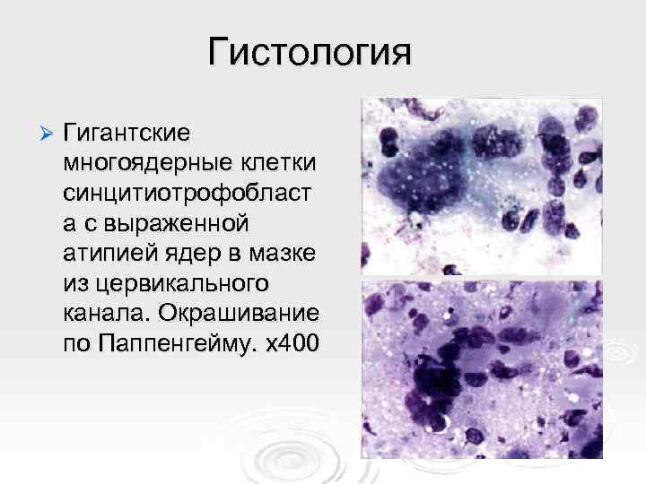 Гистология Ø Гигантские многоядерные клетки синцитиотрофобласт а с выраженной атипией ядер в мазке из