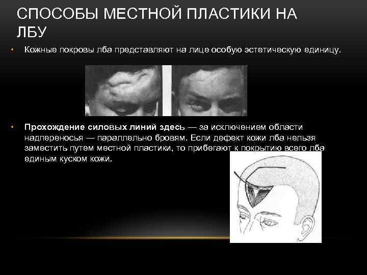 СПОСОБЫ МЕСТНОЙ ПЛАСТИКИ НА ЛБУ • Кожные покровы лба представляют на лице особую эстетическую