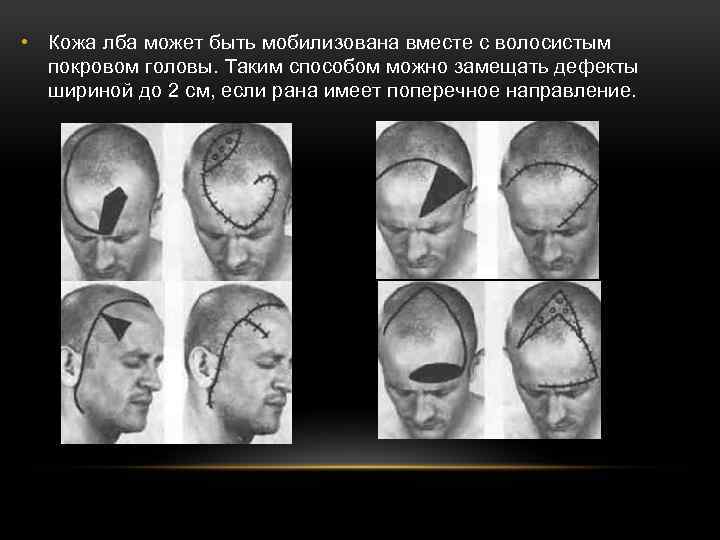  • Кожа лба может быть мобилизована вместе с волосистым покровом головы. Таким способом