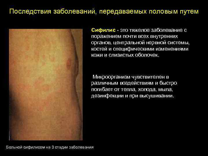 Последствия заболеваний, передаваемых половым путем Сифилис - это тяжелое заболевание с поражением почти всех
