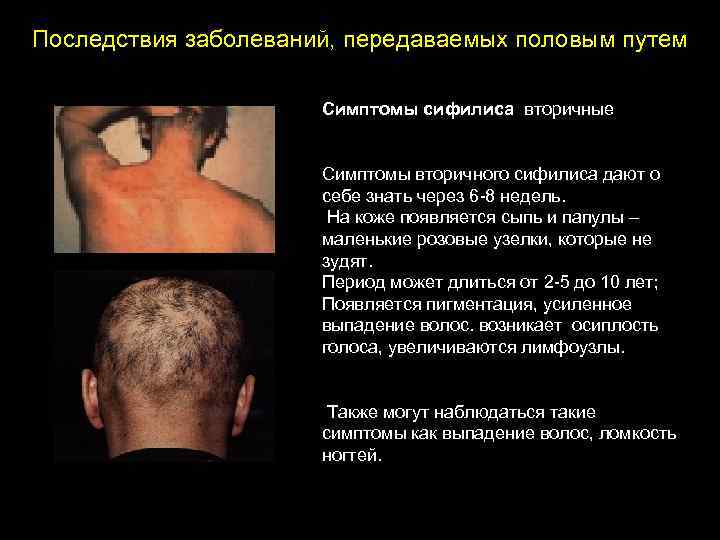 Последствия заболеваний, передаваемых половым путем Симптомы сифилиса вторичные Симптомы вторичного сифилиса дают о себе