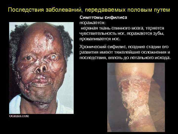Последствия заболеваний, передаваемых половым путем Симптомы сифилиса поражается: нервная ткань спинного мозга, теряется чувствительность