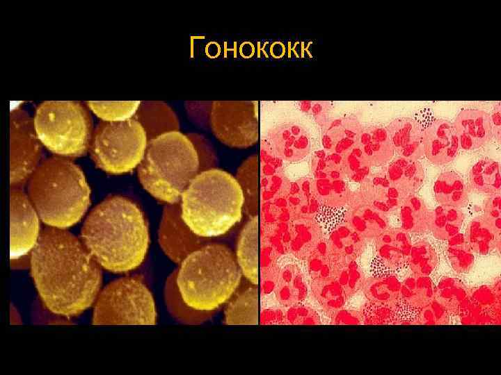 Гонококк 